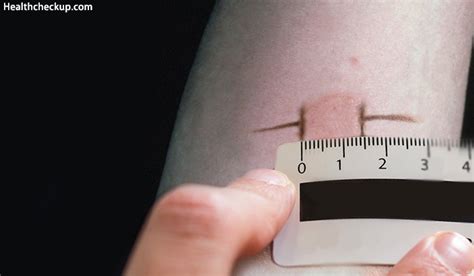 Skin allergy test, how to read allergy skin test results & side effects.